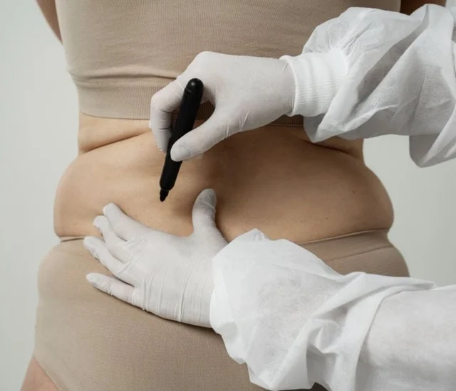 A detailed view of a medical professional marking a patient's abdominal area with a black marker, we.