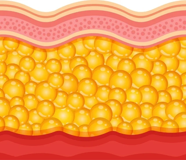 A layer of yellow fat cells beneath the skin with skin layers above and below.