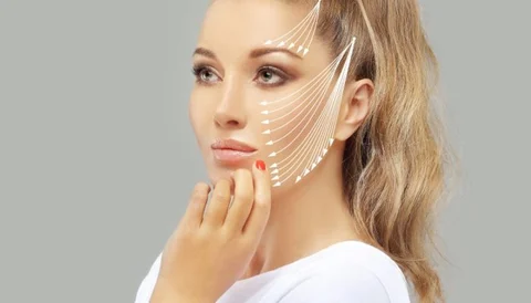 Woman with facial skin lifting lines and markings for a thread lift procedure.