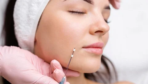 A woman receiving a thread lift procedure with a needle near her cheek.