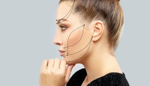A woman with her hair in a bun, showing facial contouring lines and points for a thread lift procedu.