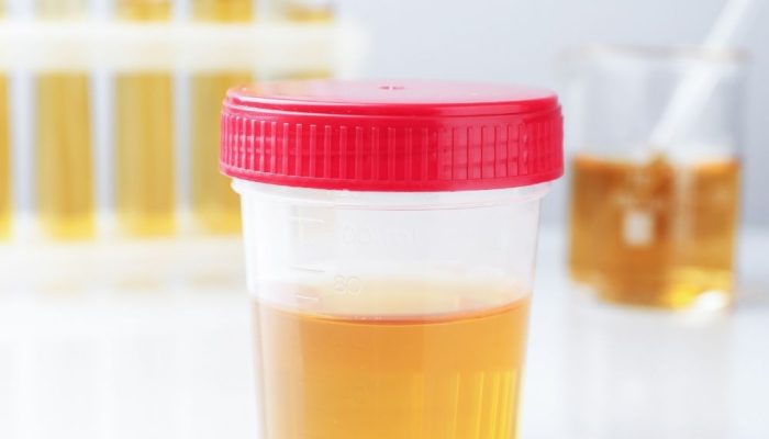 Urine sample in a clear container with a red lid on a white surface.