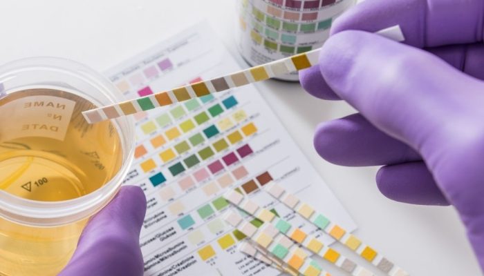 A person wearing purple gloves holding a urine test strip over a color chart and a container of urin.
