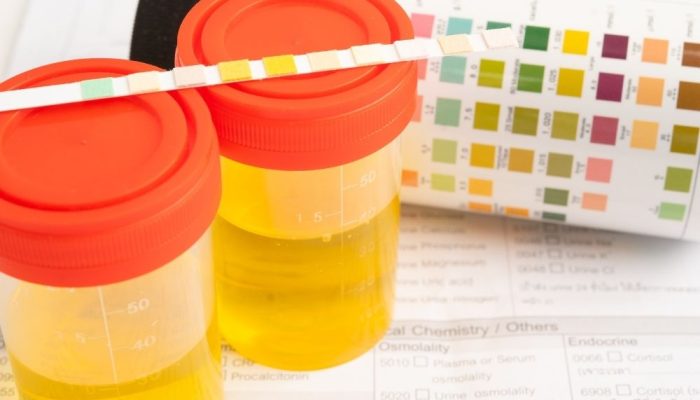 Two yellow urine sample containers with red caps and a dipstick strip on top.